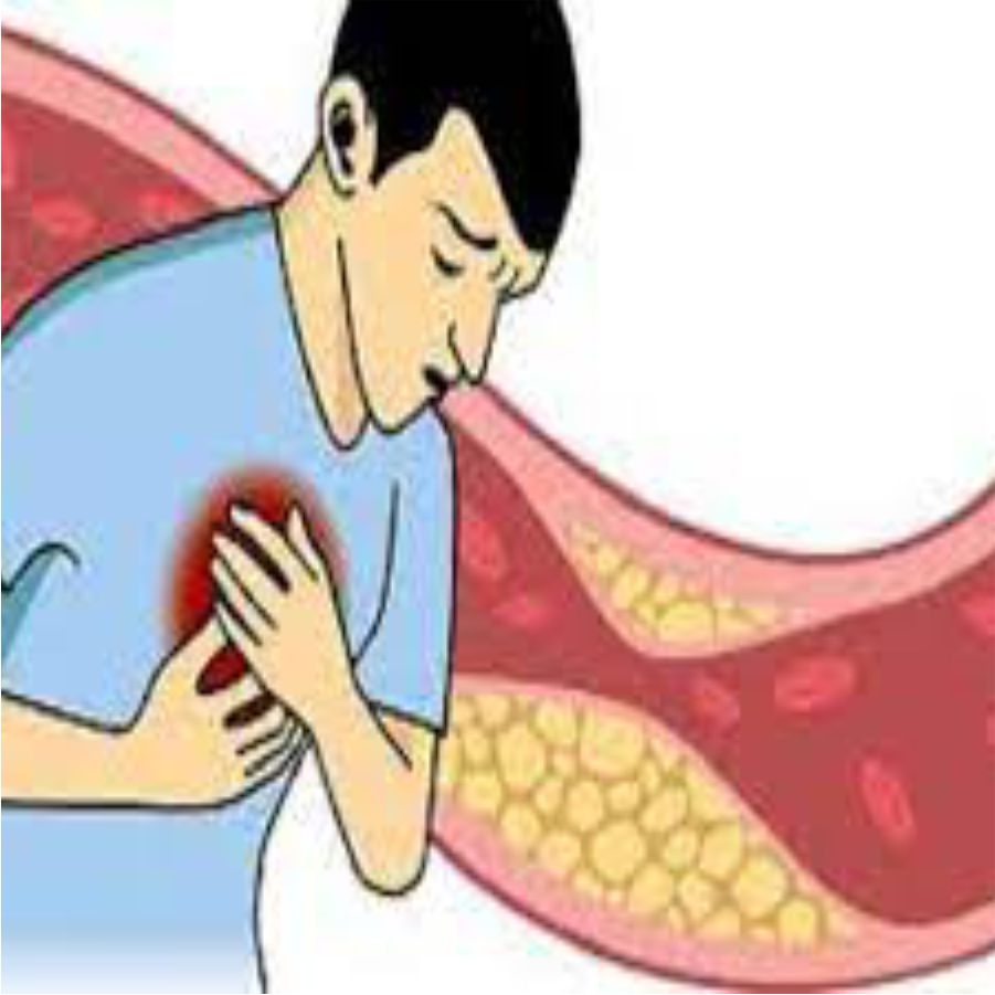 Atherosclerosis, Stroke