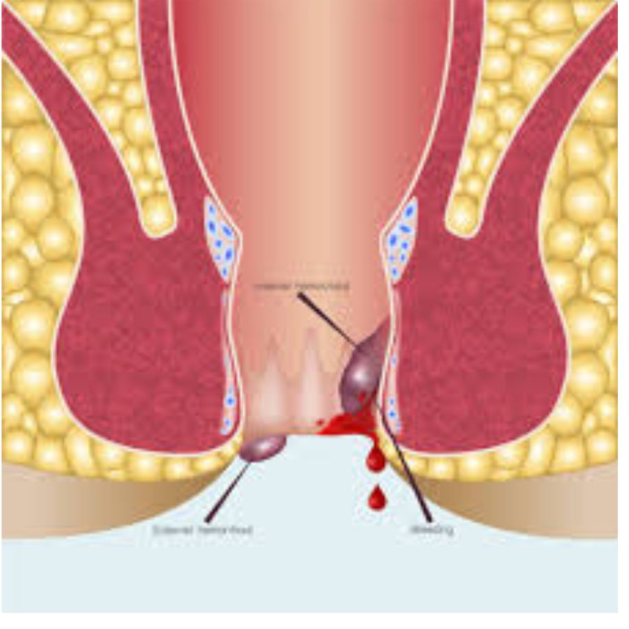 Haemorrhoides