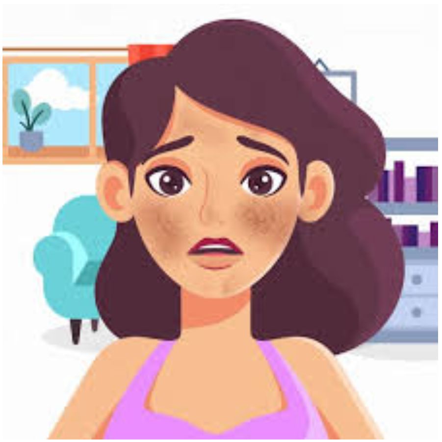 Melasma