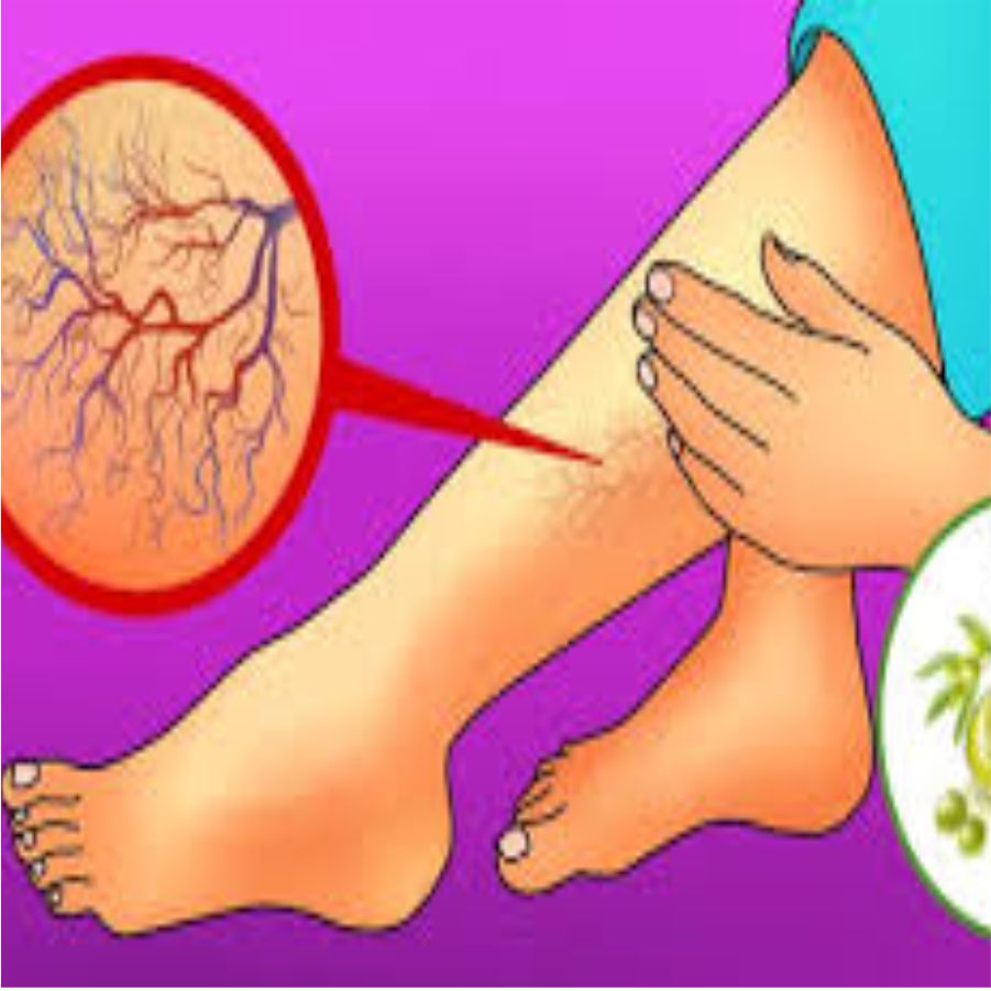 Varicose Veins